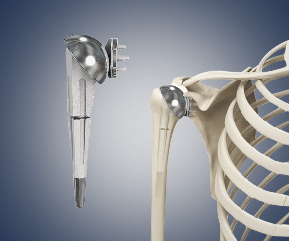 Shoulder Joint Replacement