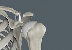 Acromioclavicular (AC) Joint Reconstruction