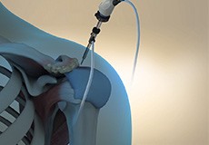 Arthroscopic Surgery