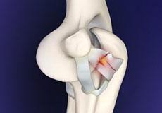 Ligament Reconstruction