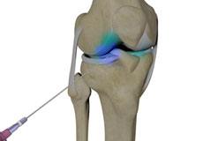 Intra-Articular Joint Injections